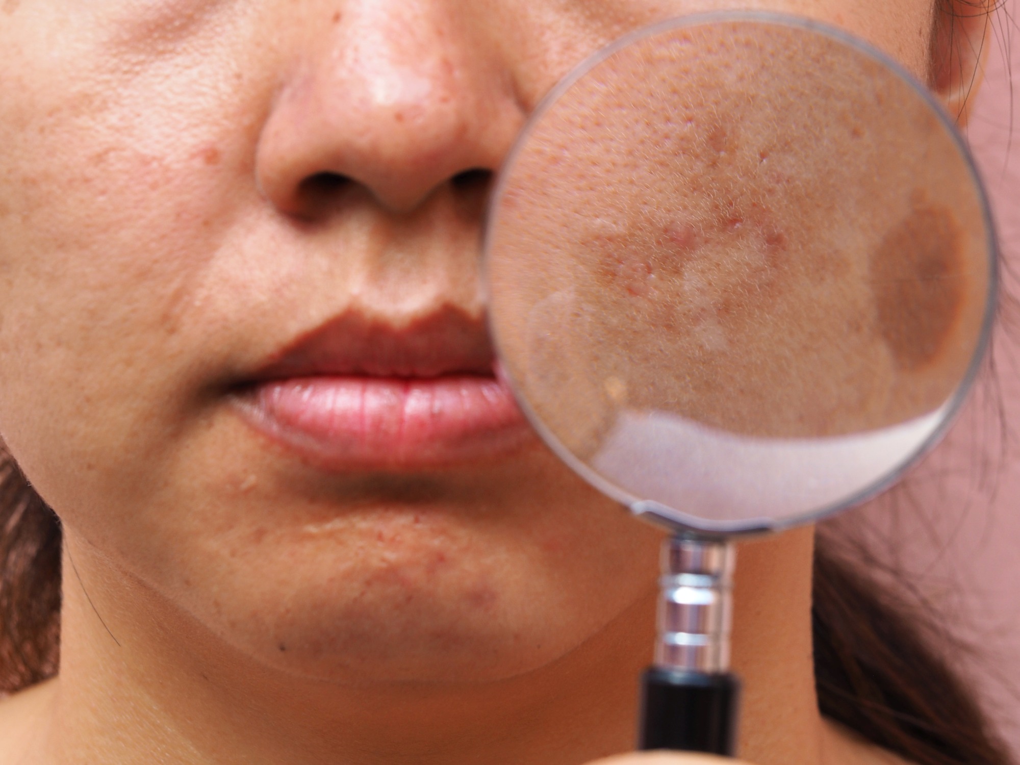 Hiperpigmentacja skóry leczenie