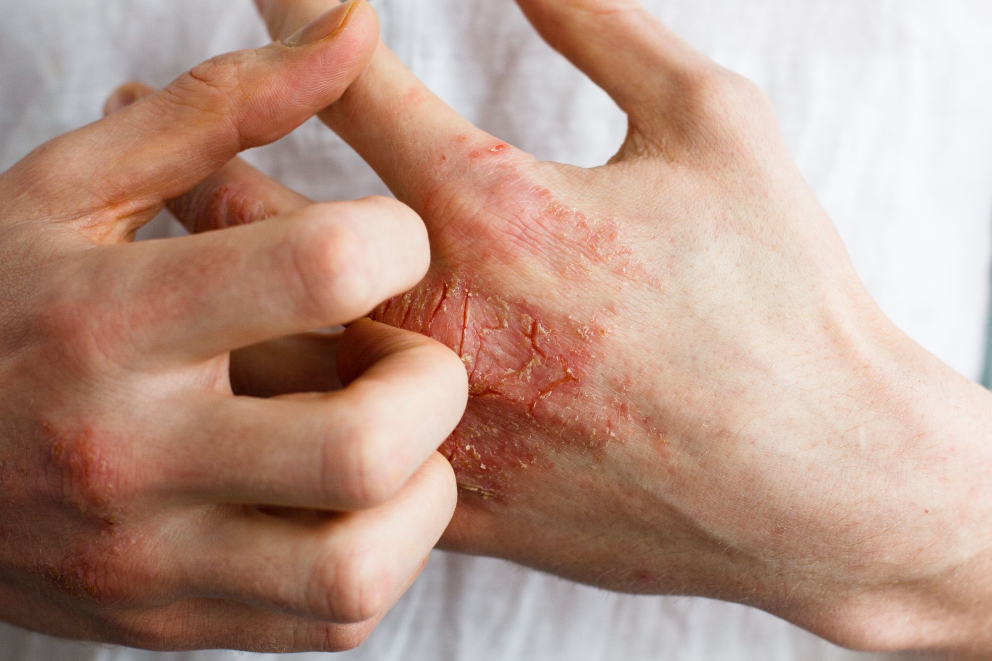 Pękająca skóra dłoni do krwi - jak wygląda?