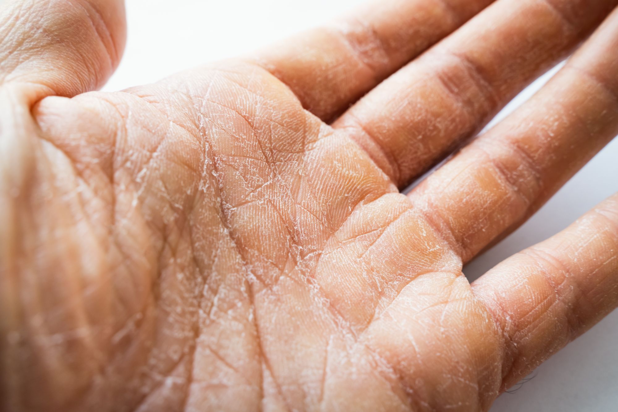 Sucha i pękająca skóra na dłoni
