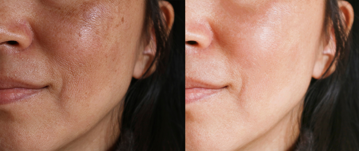 skóra przed i po kuracji kwasem traneksamowym
